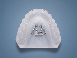 TAD Expander, Bone-Borne