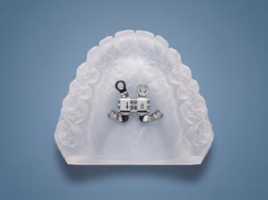 TAD Expander, Bone-Borne