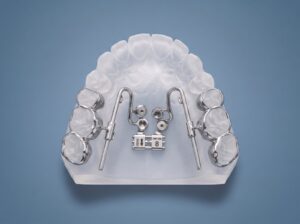 TAD Expander, Bone and Tooth-Borne with hooks